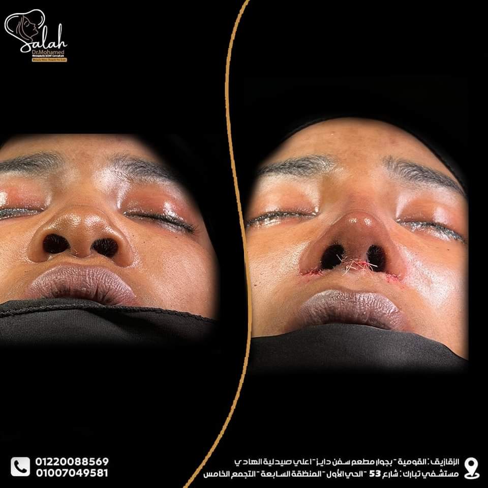African Nose Rhinoplasty